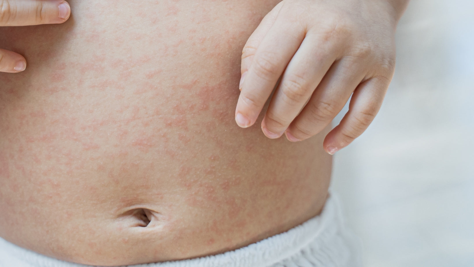 How Goat Milk Formula Can Help Heal Skin Conditions and Eczema in Children